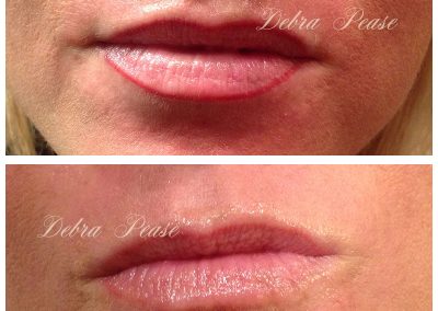 Lipliner - Immediately After and Healed